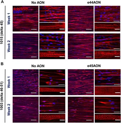 Modeling Patient-Specific Muscular Dystrophy Phenotypes and Therapeutic Responses in Reprogrammed Myotubes Engineered on Micromolded Gelatin Hydrogels